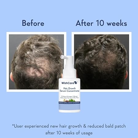 WishCare Hair Growth Serum Concentrate - 3% Redensyl, 4% Anagain, 2% Baicapil, Caffeine, Biotin & Rice Water - Advanced Hair Growth Serum for Hair Fall Control & Hair Growth 30ml